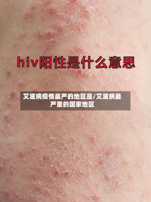 艾滋病疫情最严的地区是/艾滋病最严重的国家地区